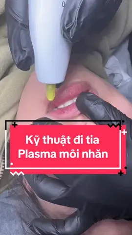 Kỹ thuật đi tia Plasma môi nhăn như thế nào để đạt kết quả tốt nhất#giangbeautyplasma #xuhuongtiktok #plasmafibroblast #plasmaxoaseo #plasmamoitham 