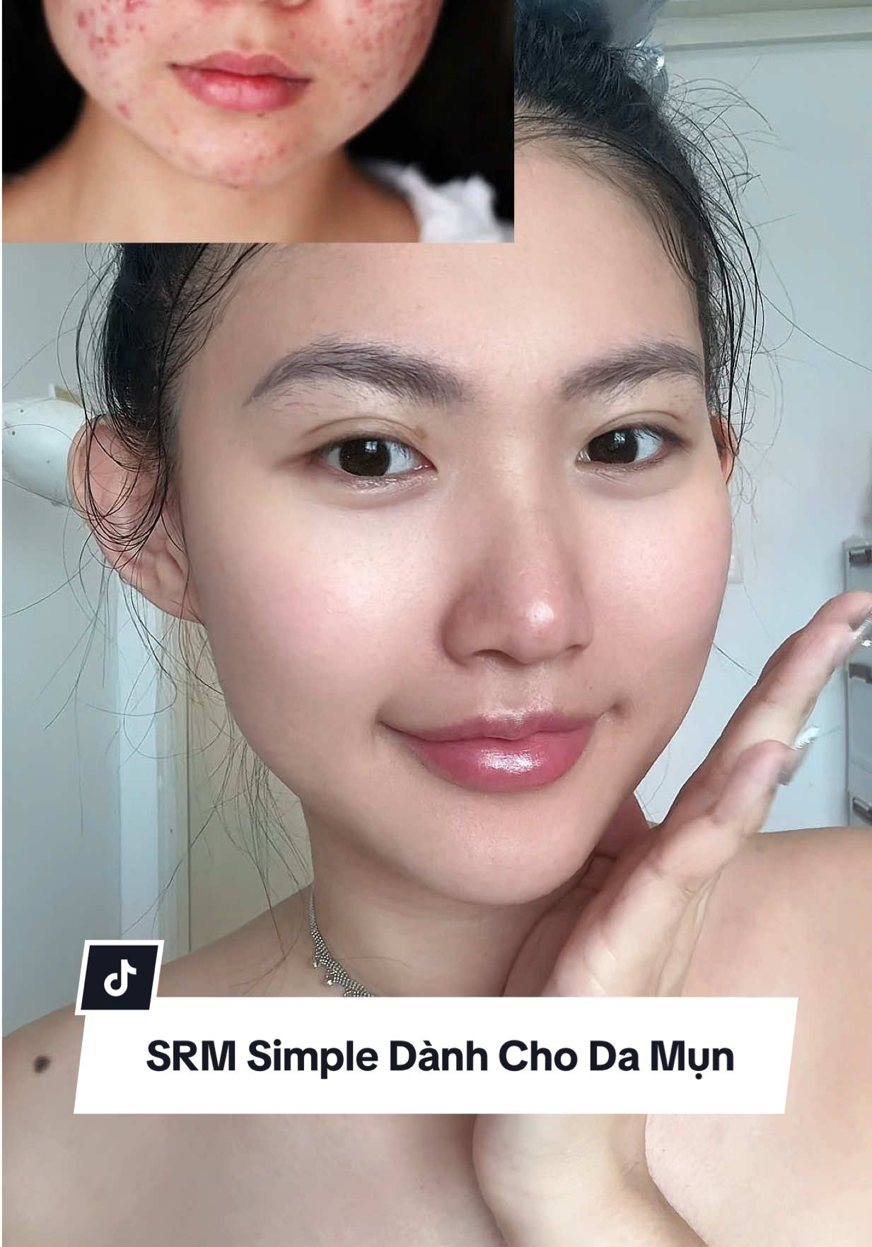 Sữa rửa mặt chân ái dành cho cho da mụn nè #dongianlaSimple #damunchonSimple #SkinTwin #hoptaccungUnilever 