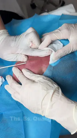 Clip này truyền động lực cho những bạn đang bị sẹo và đang phân vân có điều trị sẹo hay không . Hãy điều trị khi sẹo còn mới và ít để có 1 làn da  đẹp trở lại #thsbsquangdanh #bsdl #xuhuong #sẹorỗ 