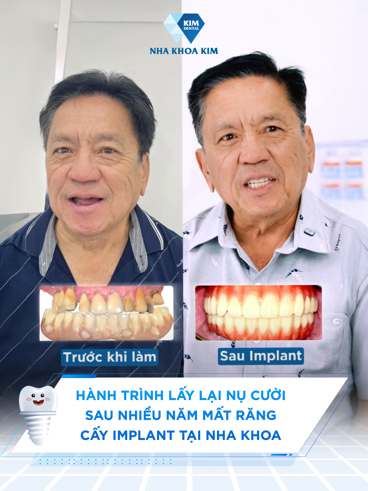 Hành trình lấy lại nụ cười sau nhiều năm mất răng – Cấy implant tại nha khoa  #nhakhoakim #Implant #chinhnha #maccaisu #niengrang #xuhuong