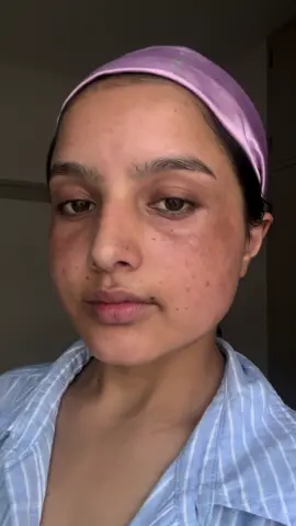 You’re not stuck. If you don’t like your current self, start changing — step by step, you can glow again. ✨ #MelasmaJourney 💛 My melasma and hyperpigmentation journey video coming soon.  starts with self-love 💛✨ #MelasmaJourney #HoneySkin