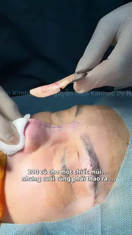 200 củ một chiếc mũi liệu có xứng đáng…🥲#suamui 