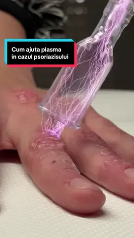 #psoriazis #tratament #coldplasma #carlalaszlo 