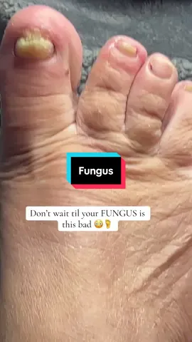 When I first started showing fungus between my toes, I tried everything sprays, creams, all of it. Nothing worked until I found out about undecylenic acid. That’s the ingredient that actually kills the fungus deep at the root. Lunavia’s antifungal pen has the highest dose you can get you just paint it on twice a day. It’s been selling out like crazy, so if it’s in stock right now, hit that orange cart fast. #fungus #nailfungus #fungustreatment #nailtok 