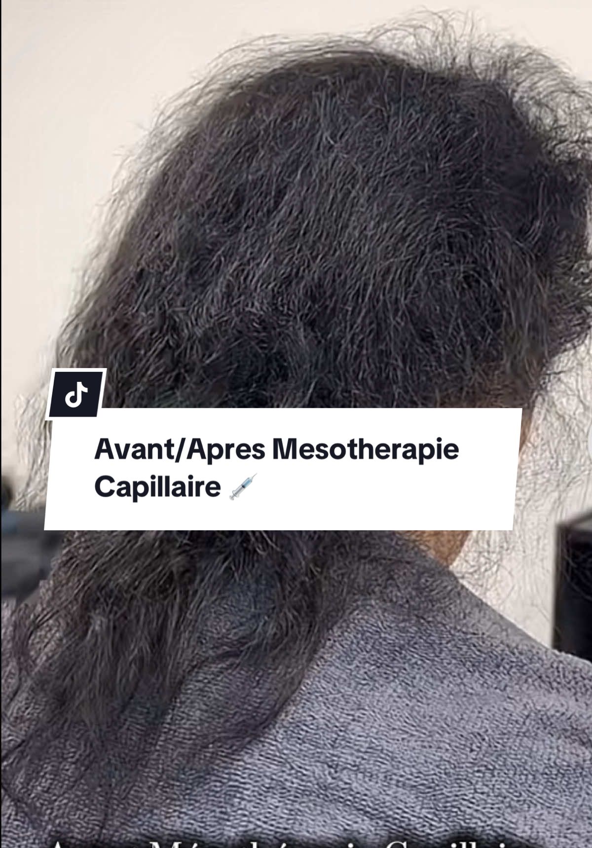 #foryouu #pourtoi #pfypシ #mesothérapie #poussedecheveux 