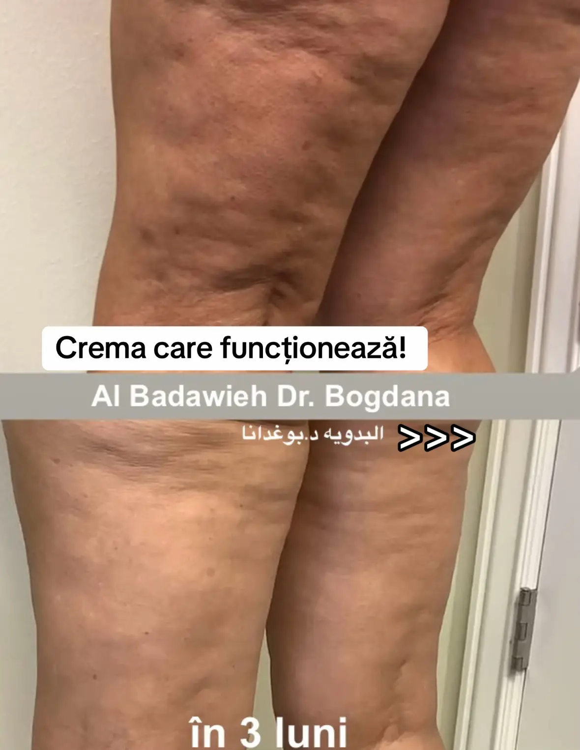 @Al Badawieh Dr. Bogdana Aceste rezultate impresionante aparțin unei doamne care a urmat cu consecvență un ritual zilnic de aplicare a cremei remodelatoare Al Badawieh Dr. Bogdana , timp de 3 luni. 🦅 Ne bucurăm să vedem încrederea răsplătită prin rezultate vizibile și să le mulțumim tuturor celor care aleg crema noastră pentru îngrijirea corporală. 🌿 Descoperă și tu eficiența formulei profesionale Al Badawieh Dr. Bogdana: 👉 www.albadawiehdrbogdana.com #crema #vegana #celulita #piele #doctorbogdana 