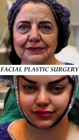 My Chinese three-point facial lift is a plastic surgery technique that completely improves facial sagging and wrinkles through surgical or non-surgical methods. The principle mainly includes the following aspects: 1. Enhancement of SMAS layer: The SMAS layer is a layer of connective tissue between the facial skin and muscles. By enhancing the SMAS layer, facial skin can be tightened, reducing wrinkles and sagging. 2. Ligament elevation: There are many ligaments on the face that connect the facial bones and muscles. By lifting these ligaments, the facial support structure can be enhanced and sagging can be reduced. 3. Fat reset: The distribution and location of facial fat can also affect the appearance of the face. By adjusting the position and distribution of fat, facial contours and lines can be improved The surgical process takes only 20 minutes to recover, and the recovery period can last for 2-3 days Sustainable results 15-20years #facelift #beauty #beautifyme #beforeandafter #antiaging