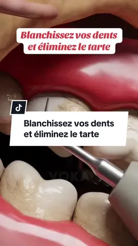 Blanchissez vos dents  et éliminez le tarte a la maison #blanchimentdentaire #tartredentaire #dentsblanches #remedenaturel 