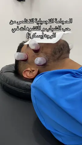 #حب_الشباب_وعلاجه #الحجامة_الطبية #حجامة_بسكرة #سعودية🇸🇦 