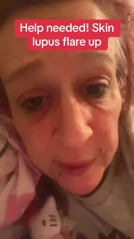 #skinlupus #lupus #cutaneouslupus #skinadvice looking for help with my skin lupus flare up please 