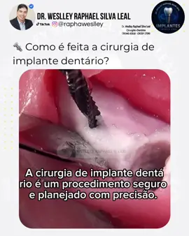 A colocação do implante dentário é uma cirurgia rápida e precisa. Após o planejamento com exames e radiografias, o profissional realiza a anestesia local para garantir o conforto do paciente. Em seguida, é feito um pequeno acesso na gengiva e o implante, uma peça de titânio que substitui a raiz do dente perdido, é inserido no osso. Depois da instalação, a gengiva é suturada e o implante passa por um período de cicatrização, no qual se integra ao osso. Finalizado esse processo, é fixada a coroa protética, devolvendo função, estética e confiança ao sorriso.