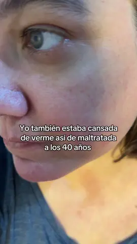 No me quería resignar a envejecer así y probé el Colageno viral de Tiktok con Resveratrol, biopeptidos activos de Colageno doblemente hidrolizado, coenzima Q10 y vit C 🤯🤯 Puedes ver resultados desde las 2-3 primeras semanas!!!! (Obvio cada cuerpo es diferente, único y especial y va a influir tu alimentación y estilo de vida), pero aunque se tarde un poco más, vale 100% la pena tomarlo y ser testigo de cómo vas rejuveneciendo 🙌🏼 . #colageno #arrugas #antiage #rosacea #nobotox 