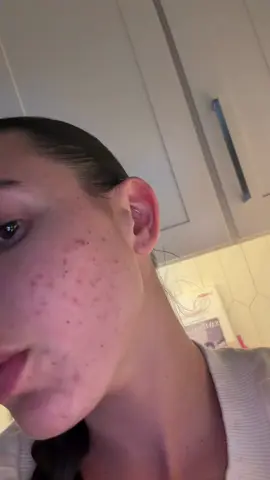 Day 12 of healing my gut/skin (definitely getting better) #guthealth #fyp #skin 