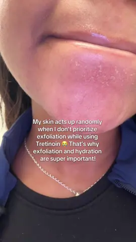 We love Tret flakes👎🏾😭.  Omg I had to take a video of how my skin looked when I was not sticking to my routine. Three things. 1. Make sure you are hydrating effectively when using Tret with a good moisturizer and I like to add a milky toner and I also love cicaplast gel. 2. Exfoliate exfoliate exfoliate. Just not on the same night or morning as Tretinoin 3. If your skin cannot handle Tret 7x/week that’s normal. Many people cannot. My sweet spot is 5x/week max if that. Take your time with Tret to avoid dryness and irritation #tretinoin #dryskin #fyp #skintips 