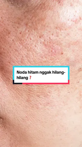 10% Niacinamide Serum bantu cerahkan kulit & samarkan dark spot. Dengan kandungan Ceramide Complex bikin skin barrier lebih kuat😊✨ Yuk klik keranjang kuning sekarang🛒 #GajianSale #glowingbarengkymmskin #kymmskinofficial #oppakymm #niacinamideserum 