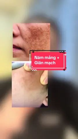 Da đỏ không xấu, chỉ là đang yếu. Vitamin K – liều dưỡng lành tính cho làn da cần được củng cố nha #prettyskin #vitakprettyskin #vitakcream #byscom #drtrang 