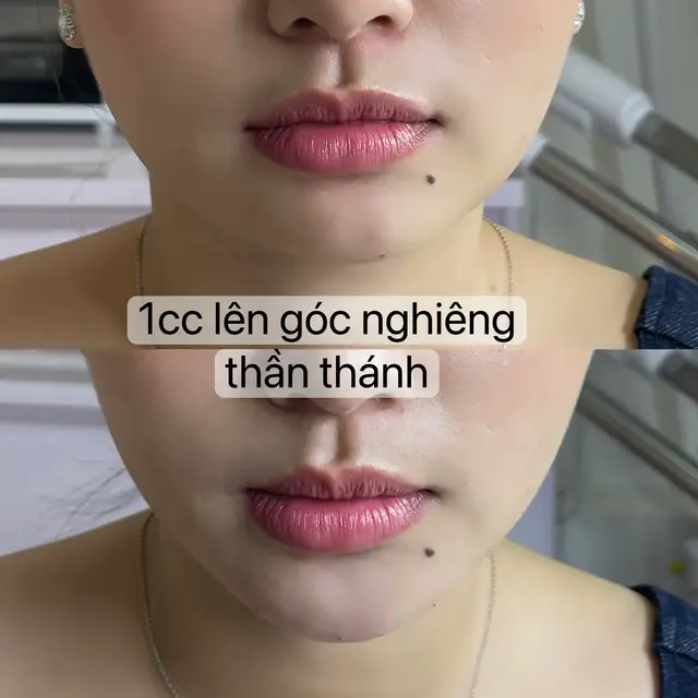 Tiêm cằm sẽ có ngay góc nghiêng thần thánh, khuôn mặt thanh tú #tiemfiller #tiemcam #tiemmoi 