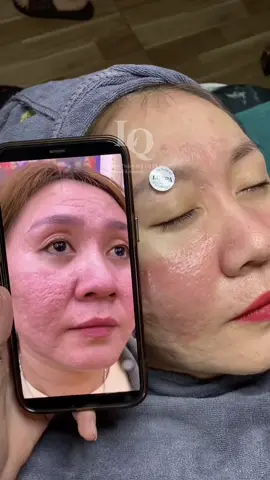 Cập nhật da sẹo #chamsocdamun#chamsocdaseo#chamsocdanam#tanbinh#Lqspa&academy