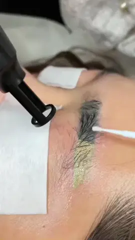 Chị ấy bảo chân mày của chị như đôi đũa cả cháy trên mặt em ạ #xoaxamlaser #xoaxam #sonalyxoaxam #xoaxamlongmay #laser #xoaxammimat #phunxamthammy 