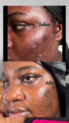 Let's talk about Retinal; the next-gen form of Retinol 👀💛 It works 11x faster, boosts cell turnover, and helps prevent early signs of aging, all while being gentle enough for sensitive skin. My skin after 7 days Brighter, smoother, and more even ✨ @KSECRET GLOBAL  	#KSECRETGlowChallenge #KSECRET #seoul1988 #retinal 