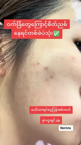 #viber09458460617 #သလဲသီးမျက်နှာသစ်ဆပ်ပြာ #ဝက်ခြံဆားဝက်ခြံအဆီဖုပျောက်ချင်မှသုံး #မပျောက်ရင်ငွေပြန်အမ်းမယ်💸✅ #မြို့ပေါင်း300အိမ်ရောက်ငွေချေပို့ပေးသည် @မလဲ့💙 