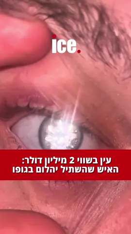 ⁨	⁨	סלייטר ג’ונס, בעל חנות תכשיטים מאלבמה שארצות הברית, הפך את עינו התותבת ליצירת אומנות כאשר הטמיע בה יהלום במשקל שני קראט, מה שהופך אותה לעין התותבת היקרה והייחודית ביותר בעולם, שלדבריו של של גונס עלה לו שני מיליון דולר על מנת ליצור אותה 💸 ג’ונס איבד את עינו הימנית בעקבות מצב רפואי, אך במקום לבחור בעין תותבת רגילה, הוא החליט ליצור בעבודה עם ד”ר ג’ון לים, העין המותאמת אישית, הכוללת יהלום אמיתי בקשתית 💎 מה דעתכם? 👇🏻⁩ 📸: _jonasjewelryco_⁩ #פוריו #כלכלה #כסף #fyp #daimond 