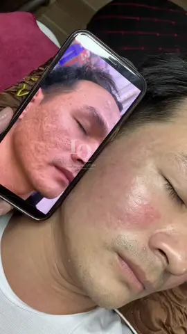 Cập nhật da sẹo #chamsocdamun#chamsocdaseo#chamsocdanam#tanbinh#Lqspa&academy