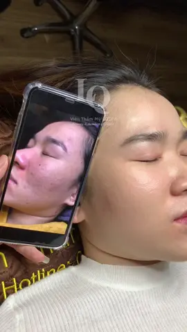 Cập nhật da mụn thâm #chamsocdamun#chamsocdaseo#chamsocdanam#tanbinh#Lqspa&academy