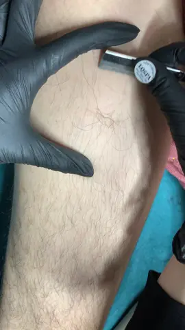 Cạo #chamsocdamun#chamsocdaseo#chamsocdanam#tanbinh#Lqspa&academy