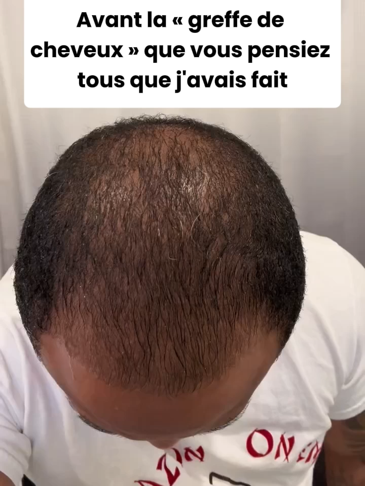C’est fini les casquettes pour cacher le crâne 💪(LIEN EN BIO)#cheveux #calvitie #poussedecheveux #hairregrowth #hairregrowthtreatment #hairloss #pertedecheveux