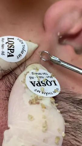 Dễ #chamsocdamun#chamsocdaseo#chamsocdanam#tanbinh#Lqspa&academy