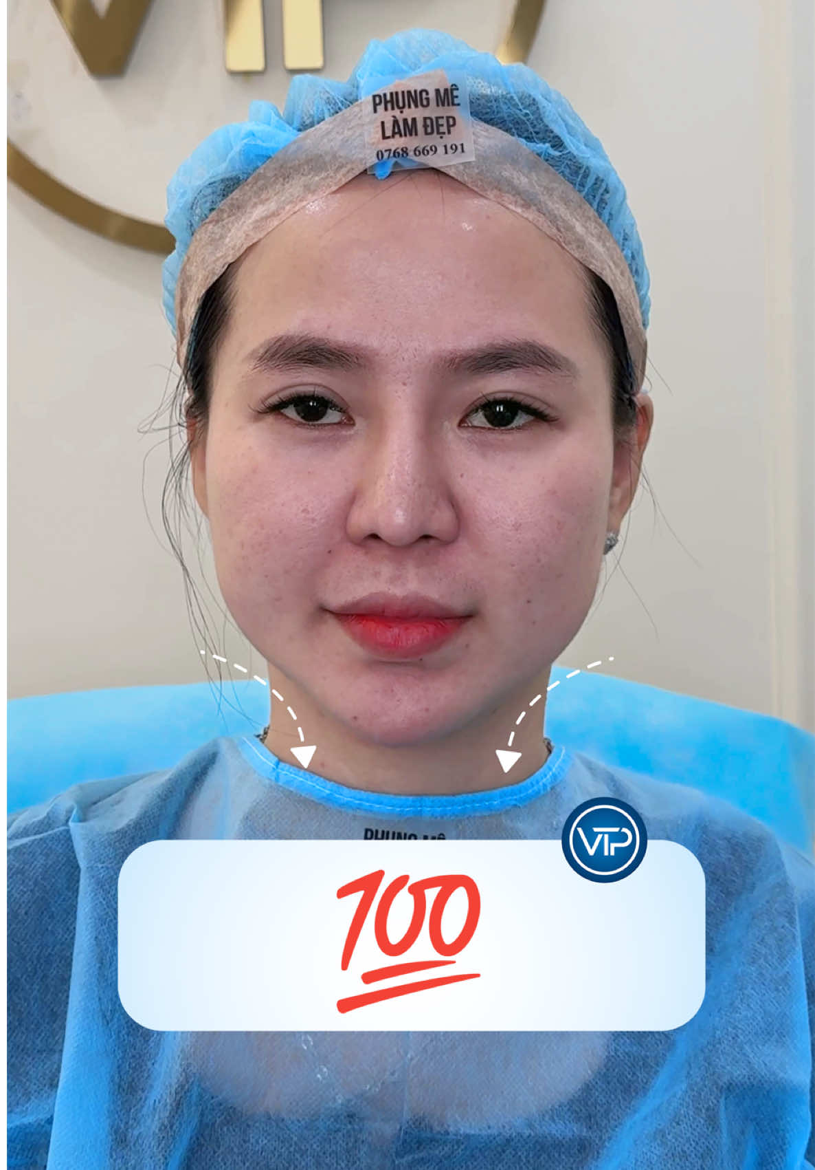 💯 #phungmelamdep #vuthiphung #canchinhguongmat #dinhcoamino #xuhuong 