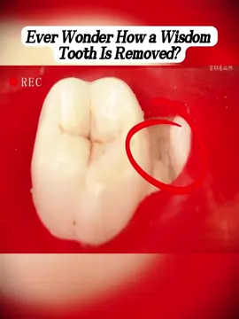 #rootcanal #treatment #tooth #restoration #oral #health