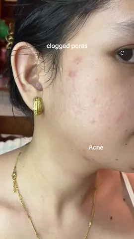 dealing with pimple marks nalang🥹 no filter, just real skin