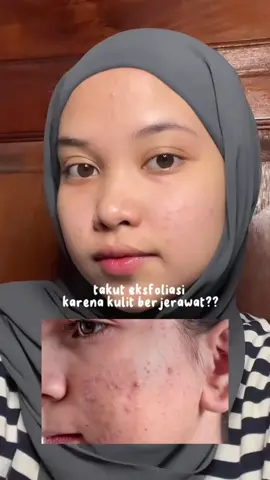Yang punya wajah berjerawat, coba untuk exfo seminggu 2 - 3x dengan Neogen Bio Peeling Pad GreenTea yang sudah ada Greentea Extract nya ya 🤗