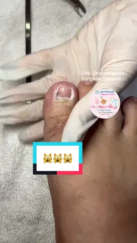 💓 #namthipnails #ตัดเล็บขบ #ตัดหนัง #ทำเล็บ #ร้านตัดเล็บขบ      Fb : namthipnails  Line : @namthipnails