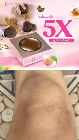 #ဒူးမဲပျောက်ချင်သူတွေအတွက် #ဂျိုင်းမဲပေါင်ကြားမဲသူများအတွက် #idol #အသားဖြူဆပ်ပြာ #foryou 