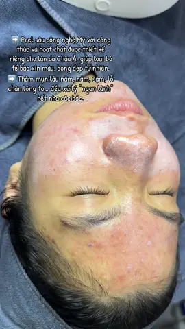 Một chiếc peel được nghiên cứu và sàng lọc suốt 5 năm, trải qua gần 100 ca lâm sàng, và đều mang lại kết quả rõ rệt, nhận được sự hài lòng tuyệt đối từ khách hàng. #thuykieubeauty8 #spabacninh #xuhuong #peelda #trangda 