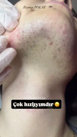 SONUÇ ODAKLIYIZ 🌸 Doğru uzman, doğru cihaz çok önemlidir.ZEYNEP  POLAT varsa %100 Çözüm’de vardır👍  #iğneliepilasyon #zeyneppolat #electrolysis #zeyneppolatiğneliepilasyon #tiktok 