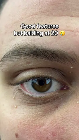 The acne has to go 🙄