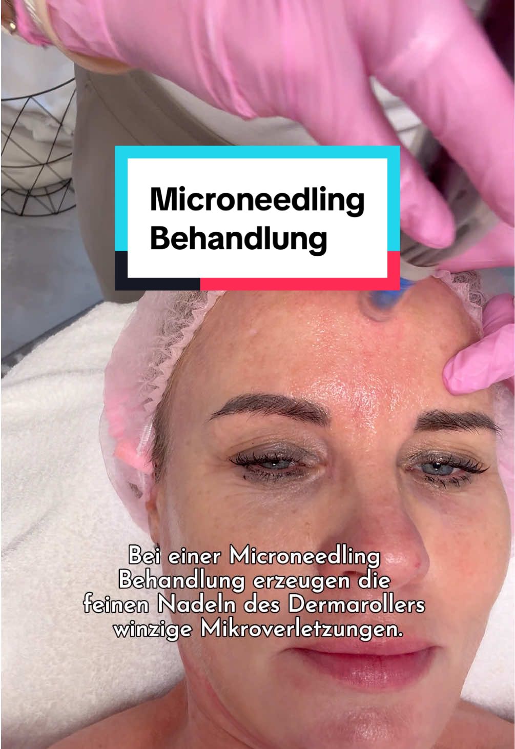 Mir ist wichtig, euch ehrliche Einblicke zu geben, ohne Filter und ohne falsche Versprechen! Beim Microneedling heißt das: direkt nach der Behandlung ist die Haut erstmal rot. Das gehört dazu und zeigt, dass die Haut arbeitet ✅ Diese Reaktion ist erwünscht, denn sie setzt genau den Prozess in Gang, den wir wollen: mehr Kollagen, feinere Poren, glattere Struktur und ein gesunder Glow ✨ Die Rötung klingt rasch wieder ab und zurück bleibt das, worauf es ankommt: ein sichtbar frischeres Hautbild 😍 Was meint ihr? Soll ich öfter mal in die Rolle der Patientin schlüpfen und euch bei meinen Behandlungen mitnehmen? 👩🏼‍⚕️ #microneedling #hautbehandlung #hautpflege #ästhetikbergstraße #drclaudiavetter 