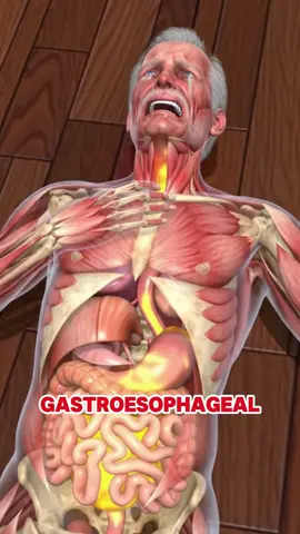 when you have GERD, these 5 warning signs will appear first #gerd #acidreflux #healthtip #usa_tiktok 