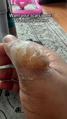 London girls, remove old and new scars with this scar gel #scar #UKSkinCare #scarremovaluk #fyp #scargel 