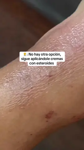 Jamás dejes que te digan que la dermatitis solo se trata con esteroides, es cierto que los esteroides tópicos son los más usados, pero no son la única opción, ni la más efectiva a largo plazo ✖️. Un enfoque holístico trabaja desde la raíz, ayuda al cuerpo a equilibrarse, fortalece la piel desde adentro y busca las causas reales detrás de los brotes, no se trata solo de tapar los síntomas, sino de sanar de verdad 🫶🏽. Y ese es el corazón de Scrachee, educar, acompañar y ofrecer alternativas seguras para que cada persona pueda encontrar alivio real y duradero, porque tu piel merece más que una solución temporal 🍃. #dermatitis #eczema #eczemaawarenessmonth 