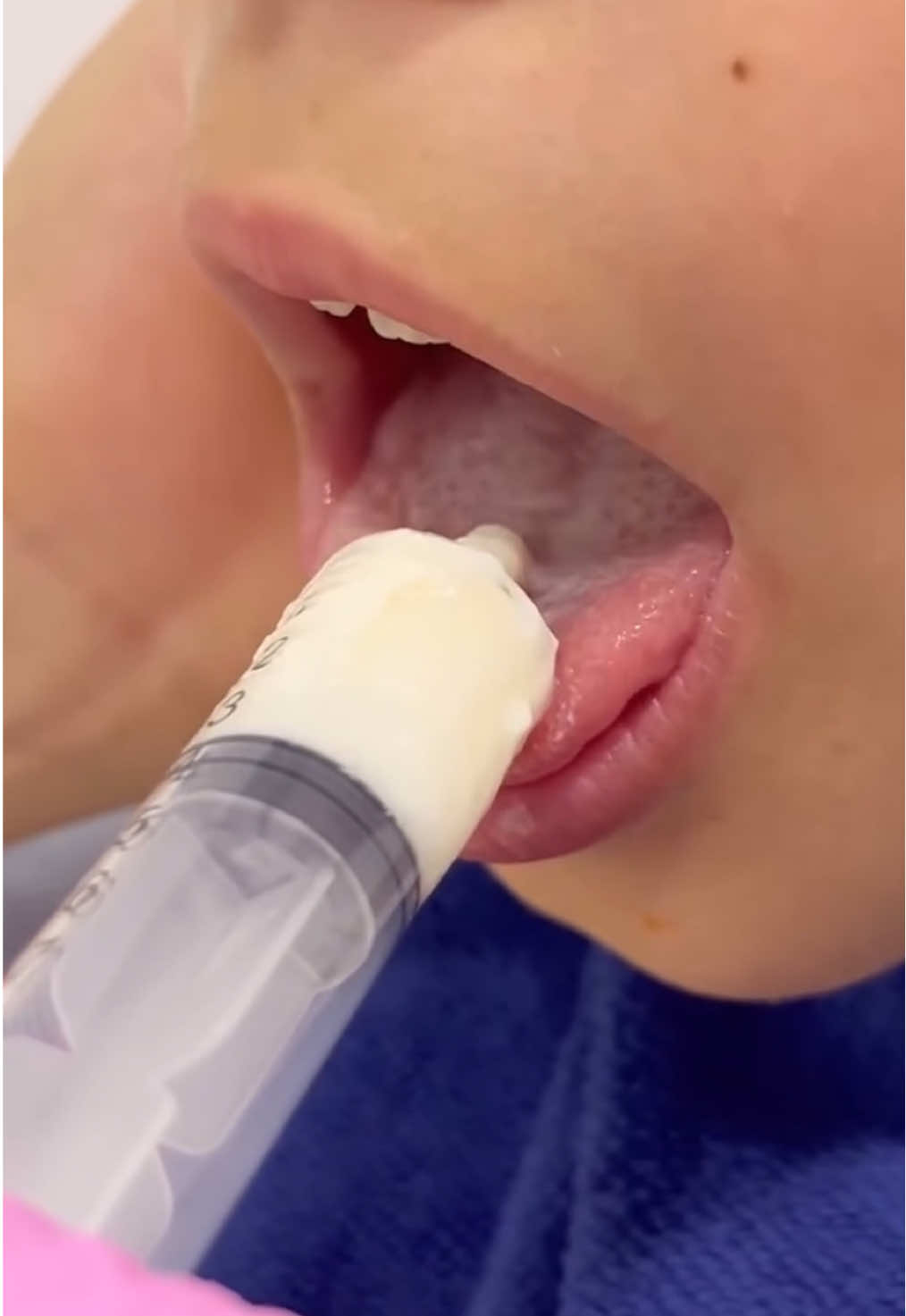 ¿Sabías que no todos tragamos de la forma correcta? En este video puedes ver la diferencia entre una deglución funcional y una deglución atípica. 	✅ El primer ejemplo vemos como realiza una deglución correcta, donde la lengua se posiciona en el paladar sin empujar los dientes. 	❌ El segundo ejemplo se muestra una interposición lingual con empuje de la lengua a los dientes, un signo claro de deglución atípica, en la que la lengua se interpone entre los dientes al tragar. 🚨 Este hábito, si no se corrige, puede afectar el desarrollo orofacial, la mordida e incluso el habla. ¡La intervención temprana es clave! 👁️ Si notas estos signos en tu peque, consúltalo con un profesional de la salud orofacial. #degluciónatípica #interposicionlingual #deglución #empujelingual #logopedia        