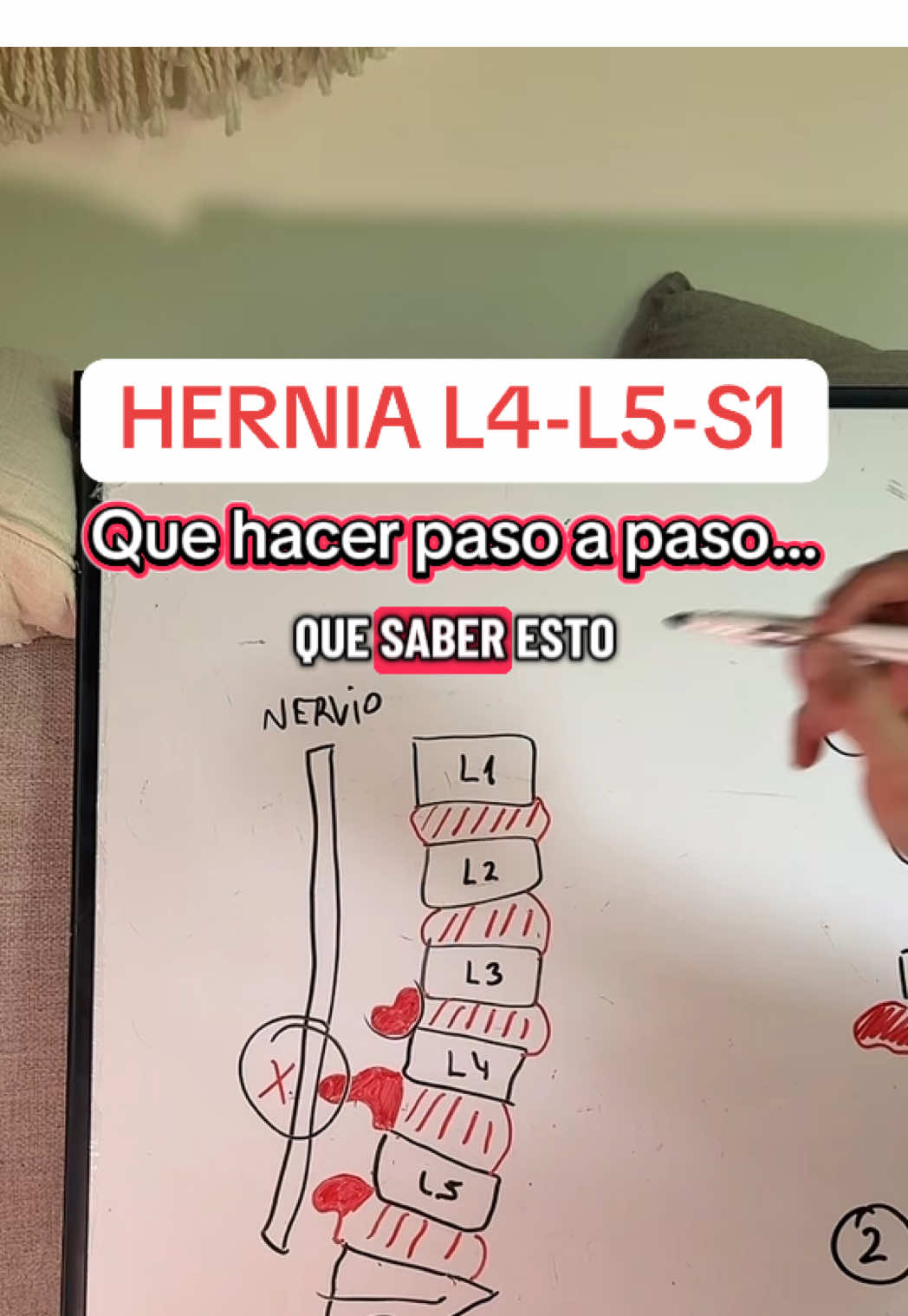 TRATAMIENTO COMPLETO PARA HERNIA LUMBAR L4-L5-S1 PASO A PASO.✅ #dolorlumbar #herniadedisco #herniadiscal 