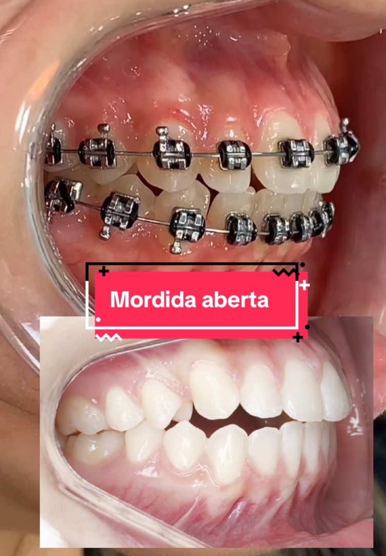 #mordida #fy #dentes #fypシ゚  #dentista 