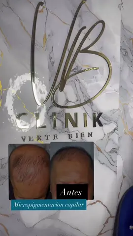 Ya conoces la micropigmentacion capilar.  ? Te ayudará a mejorar visiblemente la calvicie la alopecia o cicatrices . O dándole un espesor al cuero cabelludo para dar un aspecto más joven y de más abundante se requiere retoque cada 6 meses info Clinikvertebien Instagram 
