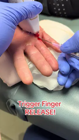 Special 18 gauge needle w/ a scalpel for Trigger finger release! #tiktokdoctor #sportsmedicine #medstudent #injections #triggerfinger 