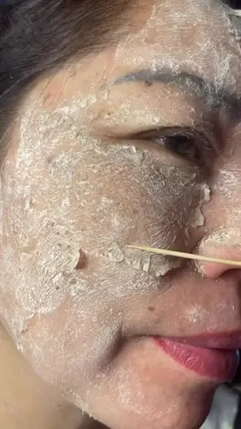 Đừng nhìn e hãy nhìn những nốt tàn nhang#peeldasinhhoc #xuhuongtiktok #neubat #tinhchathutsachsactoda #mụnnámtànnhang 